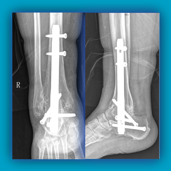Ankle Arthrodesis