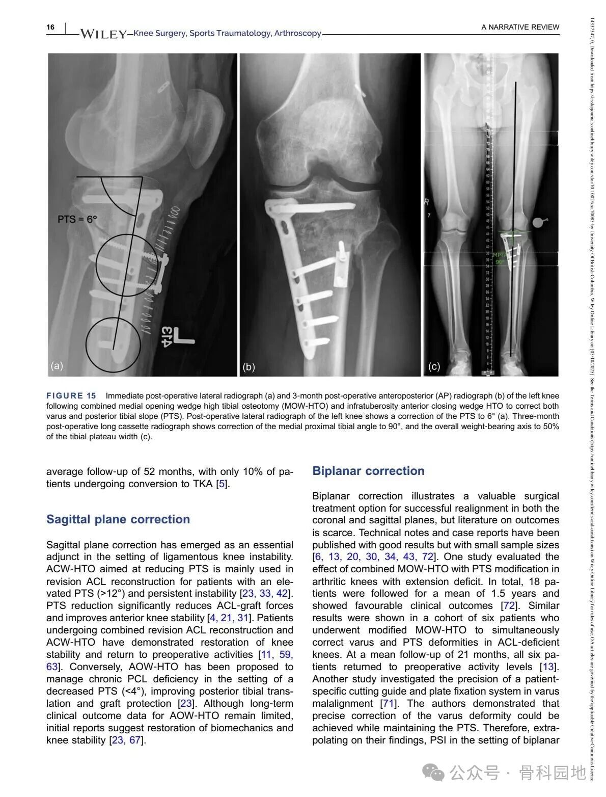 Technical Tips and Tricks for Complex Biplanar High Tibial Osteotomy