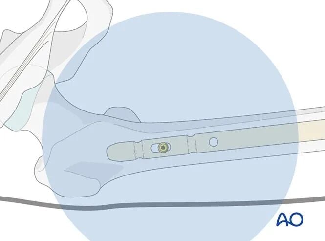 Retrograde Intramedullary Nailing for Periprosthetic Femoral Fractures After TKA: AO Standardized Surgical Strategy – Illustrated Step-by-Step Guide