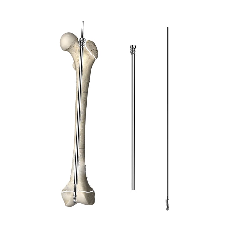 Telescopic intramedullary nail Ⅰ