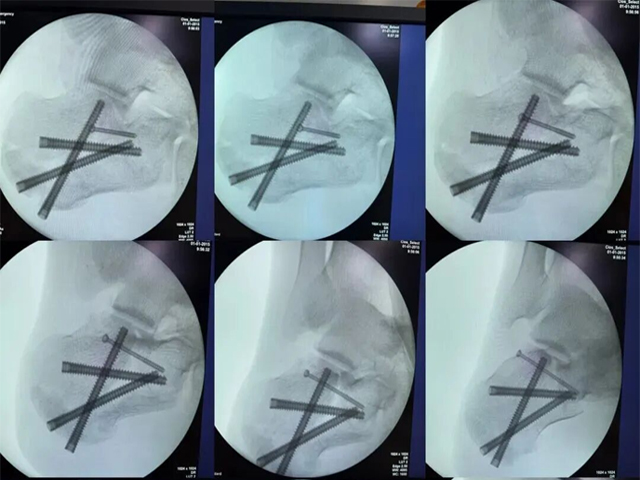 How to Perform a Successful Minimally Invasive Calcaneal Surgery