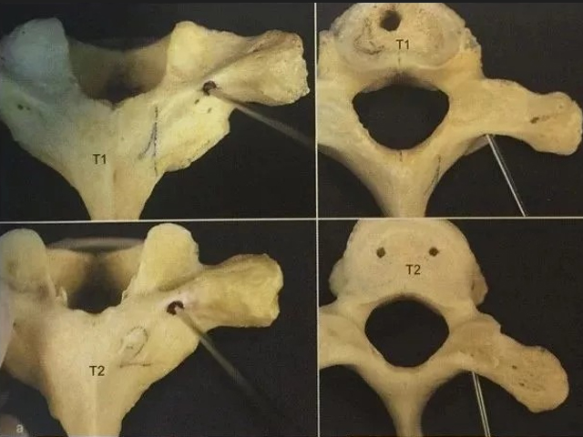 Pedicle Screw Placement Techniques for the Cervical, Thoracic, and Lumbar Spine