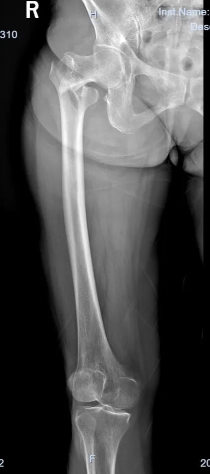 The "Gold Standard Procedure" in Orthopedics: Intramedullary Nailing for Intertrochanteric Fractures – Precise Reduction + Fast Recovery