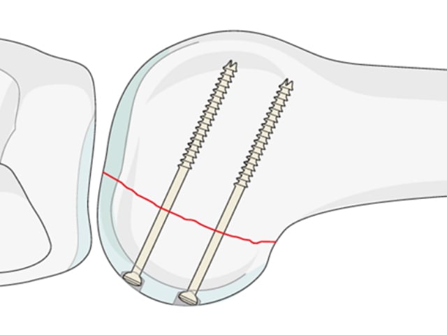Open Reduction and Internal Fixation of Hoffa Fracture with Plate and Screws
