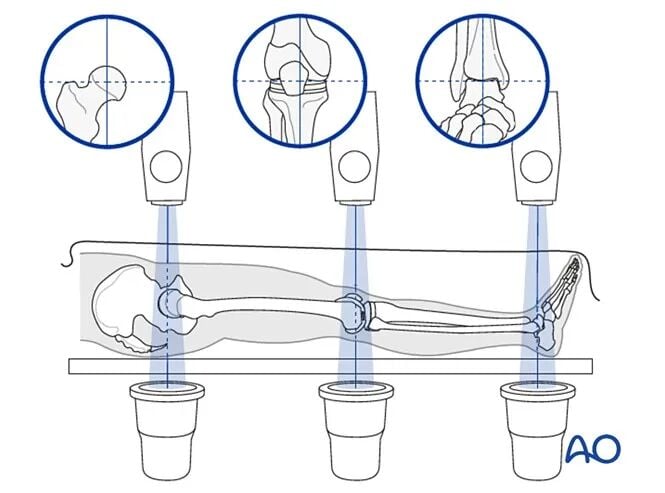 Retrograde Intramedullary Nailing for Periprosthetic Femoral Fractures After TKA: AO Standardized Surgical Strategy – Illustrated Step-by-Step Guide