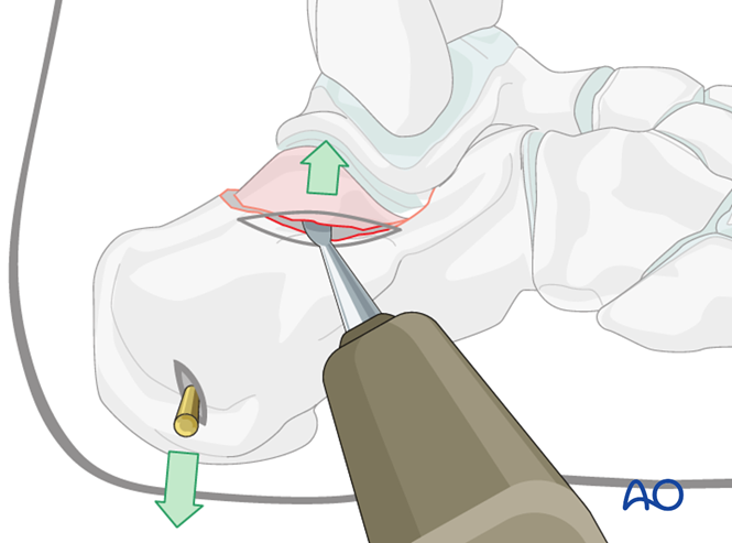 Minimally Invasive K‑Wire and Screw Fixation for Calcaneal Fractures