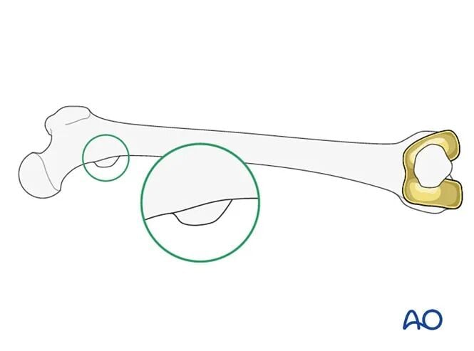 Retrograde Intramedullary Nailing for Periprosthetic Femoral Fractures After TKA: AO Standardized Surgical Strategy – Illustrated Step-by-Step Guide