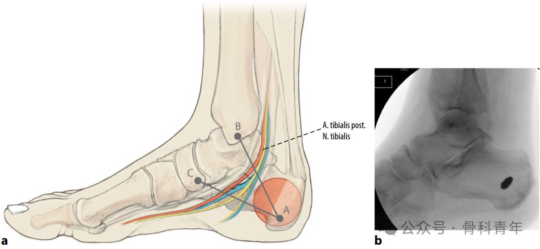 Surgical Steps
