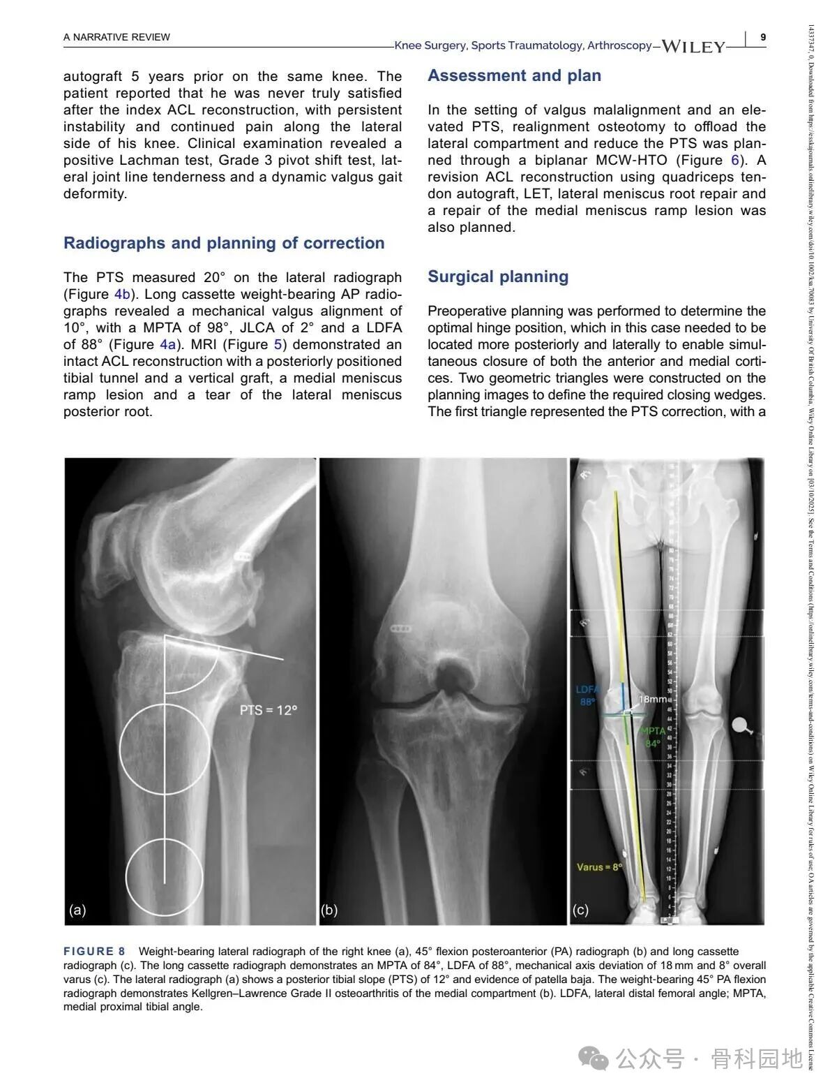 Technical Tips and Tricks for Complex Biplanar High Tibial Osteotomy
