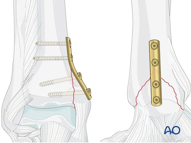 AO Standard Technique: Buttress Plate Fixation for Medial Malleolus Fractures