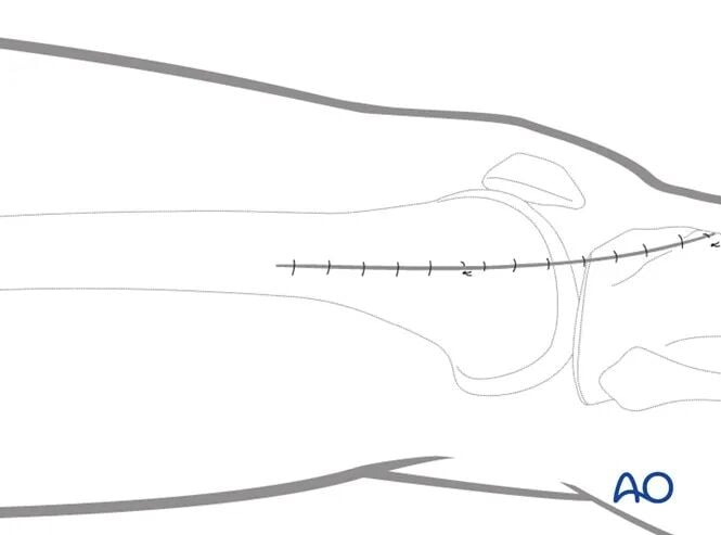 Minimally Invasive Lateral/Anterolateral MIPO Approach to the Distal Femur