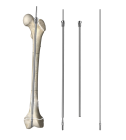 Extended Intramedullary Needle: Innovative Design Seizes the Pediatric Orthopedic Market