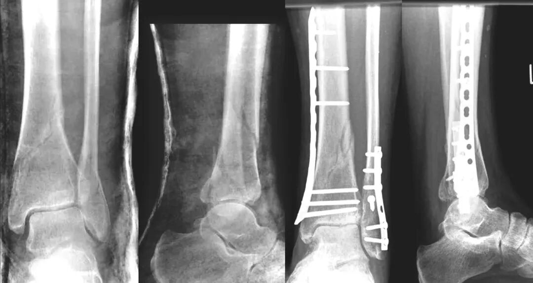 Locking Compression Plate (LCP): Principles and Clinical Applications