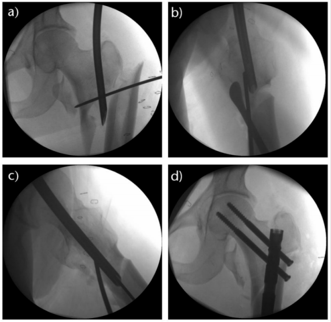 Subtrochanteric Femur Fractures: Anatomy, Classification, and Treatment Options