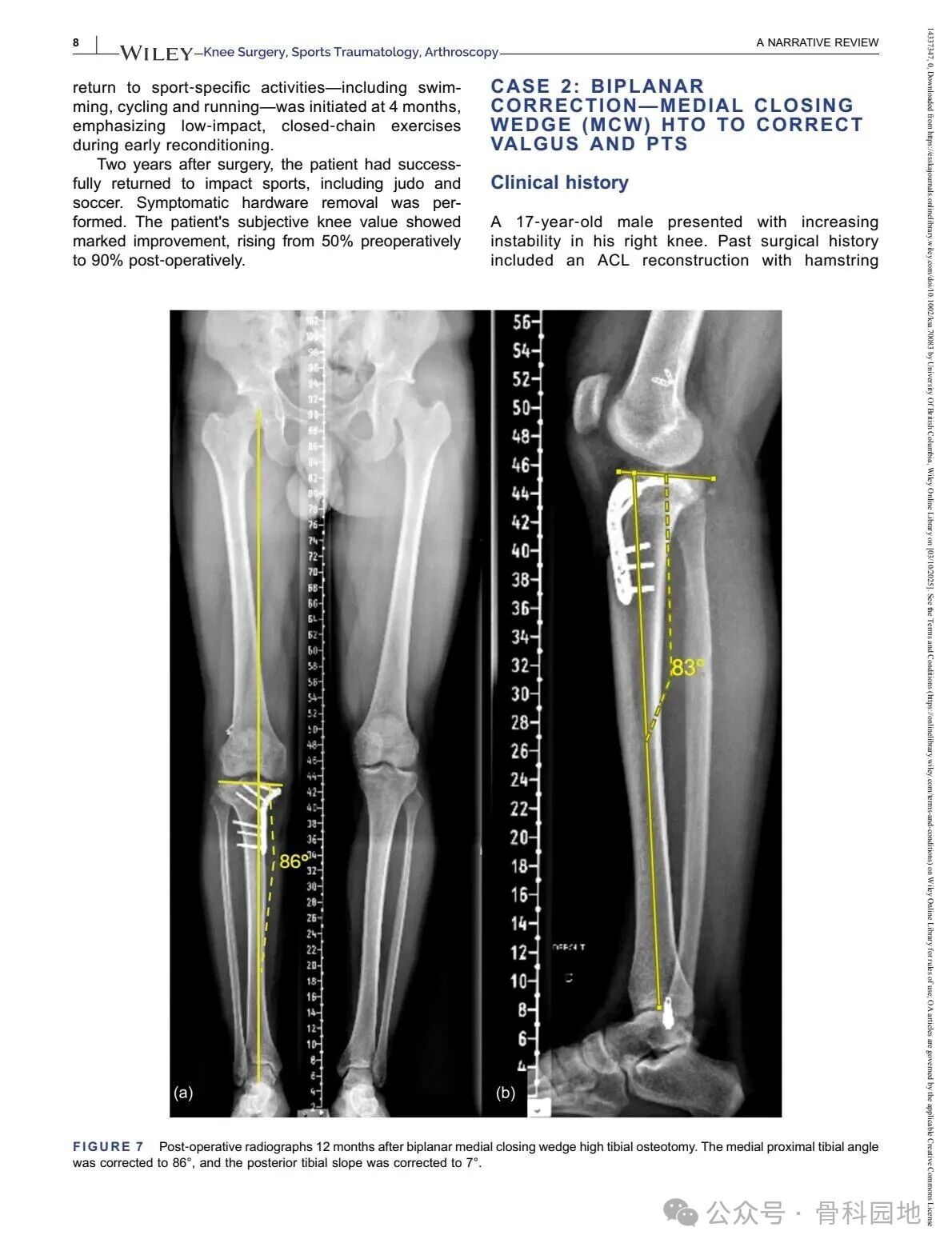 Technical Tips and Tricks for Complex Biplanar High Tibial Osteotomy