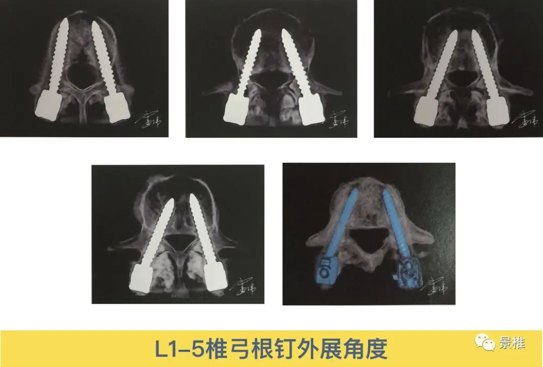 Pedicle Screw Placement Techniques for the Cervical, Thoracic, and Lumbar Spine