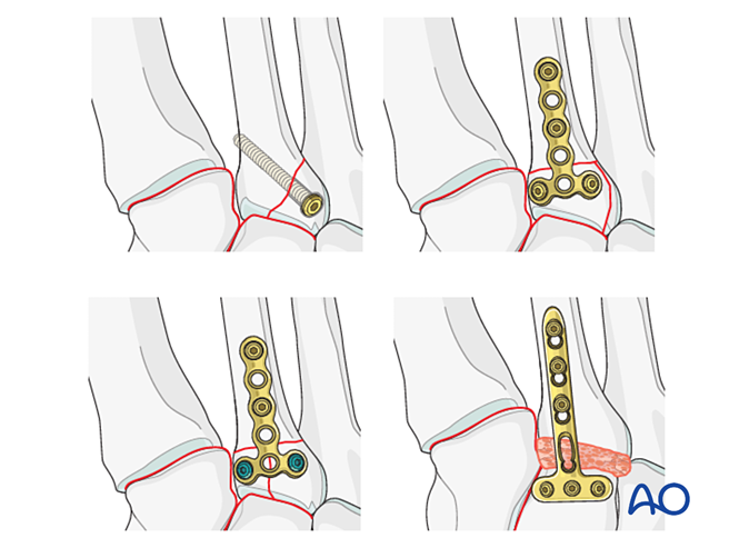 IV. Approach Preparation