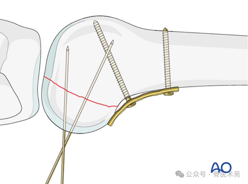 Open Reduction and Internal Fixation of Hoffa Fracture with Plate and Screws