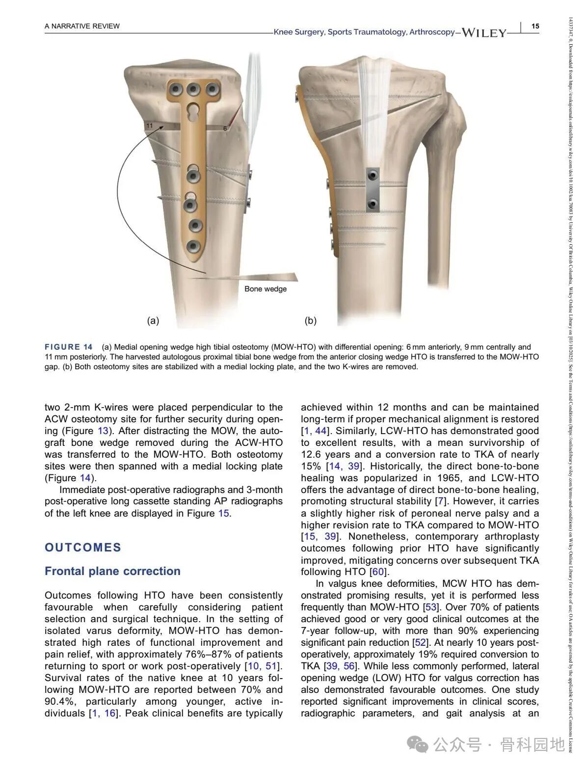 Technical Tips and Tricks for Complex Biplanar High Tibial Osteotomy
