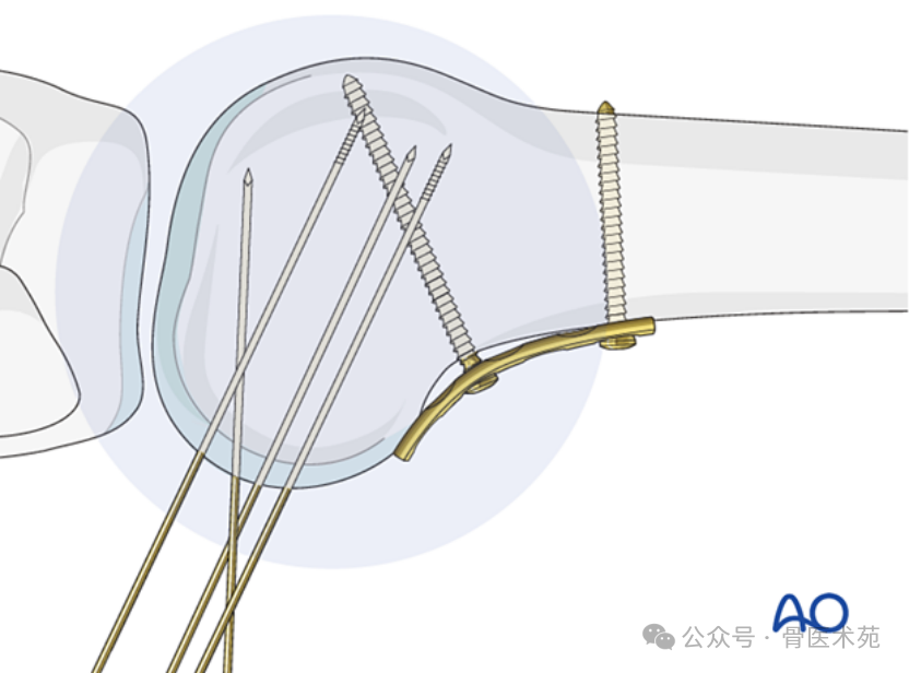 Open Reduction and Internal Fixation of Hoffa Fracture with Plate and Screws