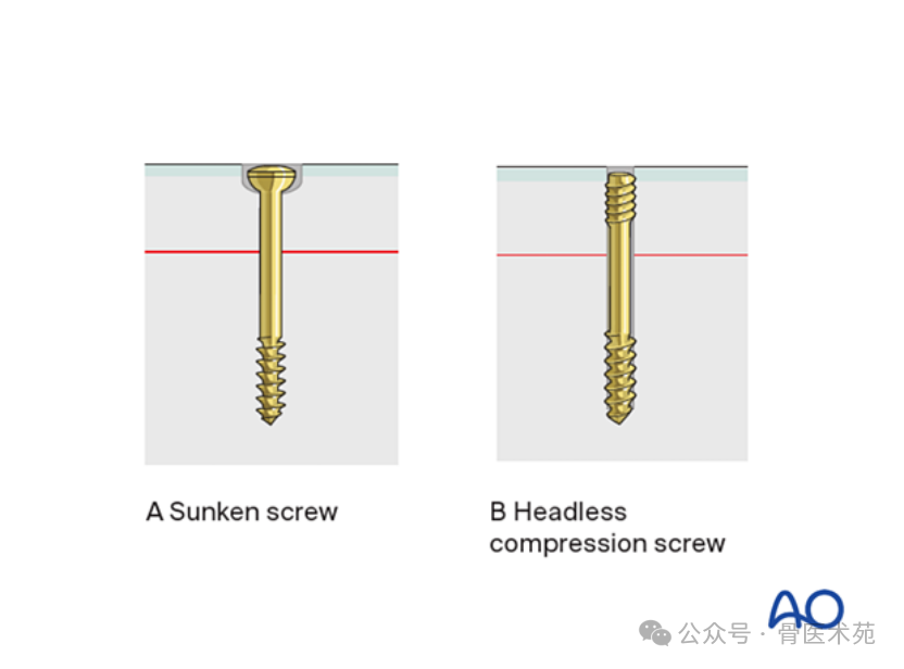 Open Reduction and Internal Fixation of Hoffa Fracture with Plate and Screws