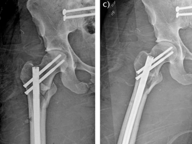 Subtrochanteric Femur Fractures: Anatomy, Classification, and Treatment Options