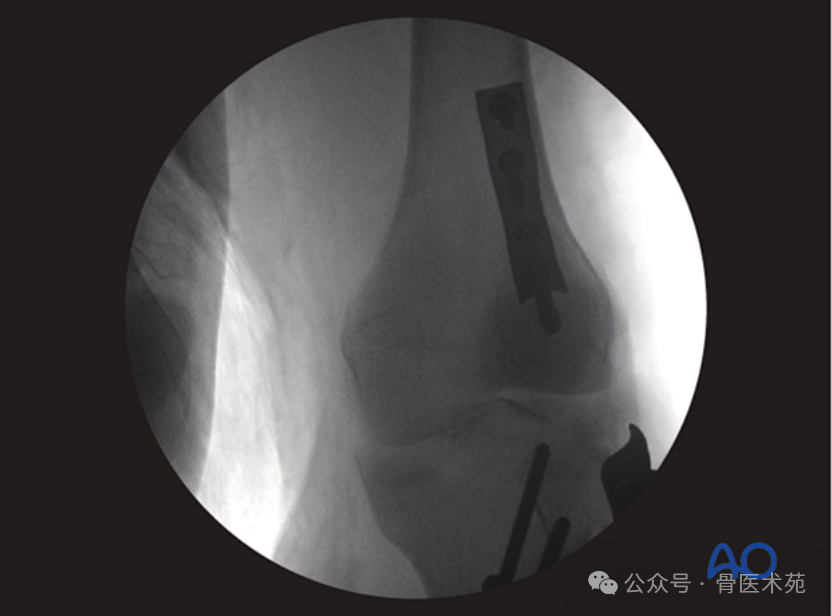 Open Reduction and Internal Fixation of Hoffa Fracture with Plate and Screws