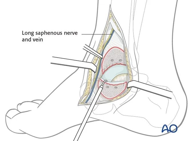 AO Standard Surgery: Screw Fixation for Displaced Talar Neck Fractures