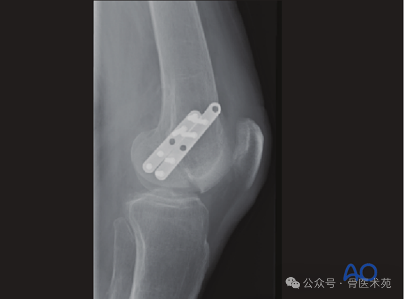 Open Reduction and Internal Fixation of Hoffa Fracture with Plate and Screws