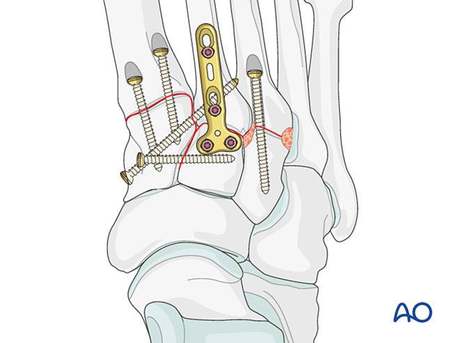 IV. Approach Preparation