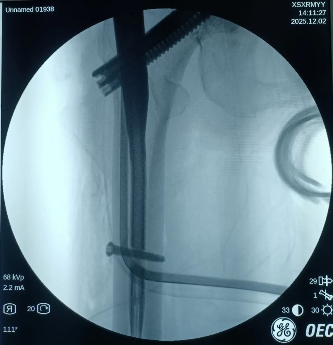 The "Gold Standard Procedure" in Orthopedics: Intramedullary Nailing for Intertrochanteric Fractures – Precise Reduction + Fast Recovery