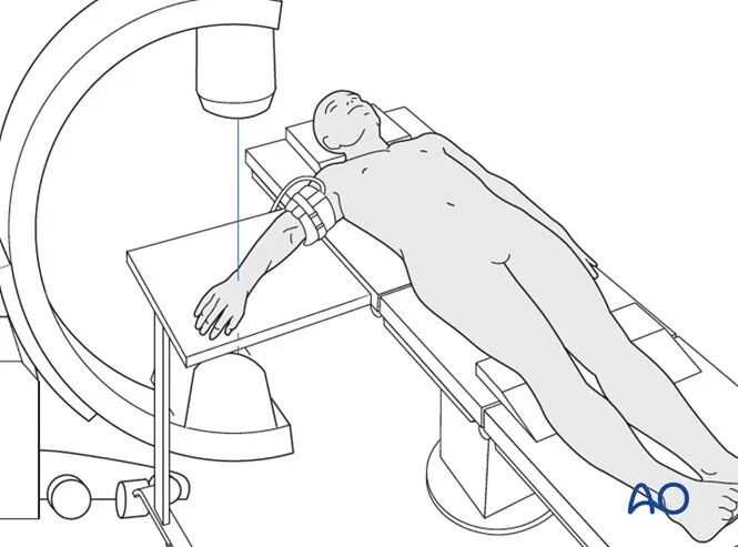 transarticular external fixation for distal radius fractures-2