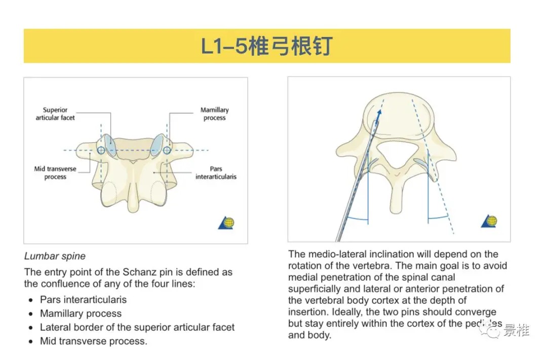 Pedicle Screw Placement Techniques for the Cervical, Thoracic, and Lumbar Spine