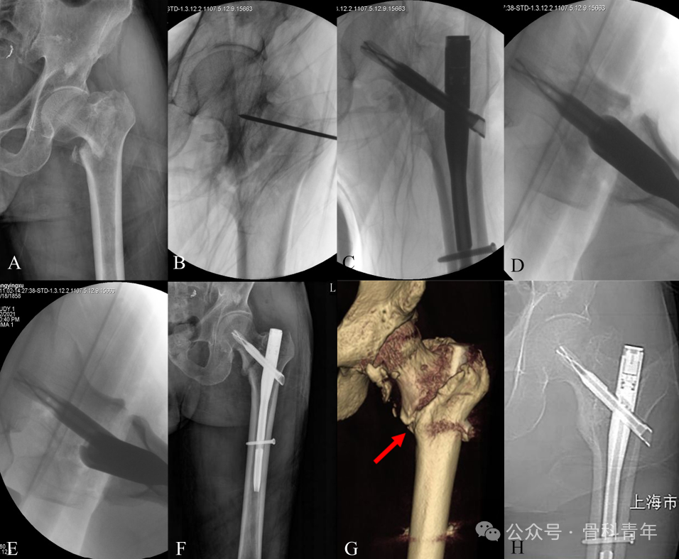 Characteristics and Surgical Techniques of the "Double‑Intra" Type of Irreducible Intertrochanteric Fractures