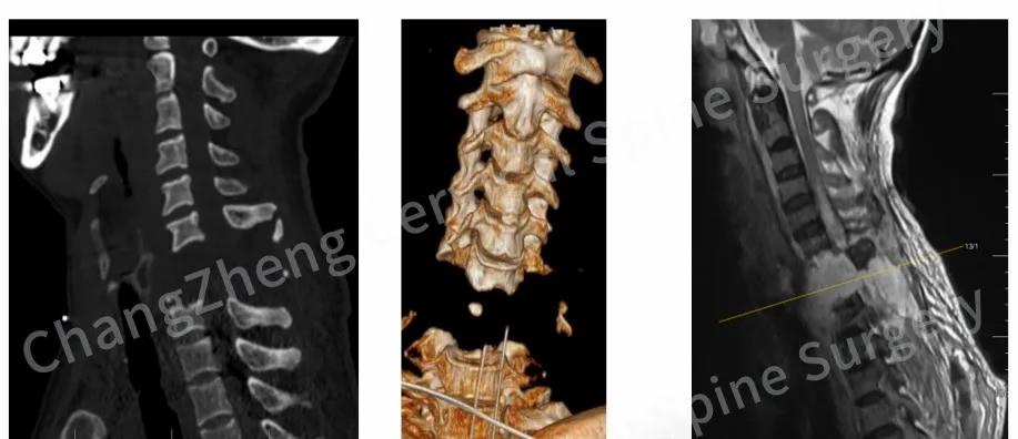 ‌Shanghai Changzheng Krankenhaus erzielt medizinischen Durchbruch bei der Behandlung einer seltenen Halswirbelverrenkung