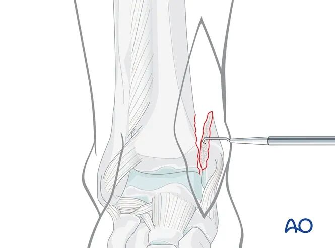 AO Standard Technique: Buttress Plate Fixation for Medial Malleolus Fractures