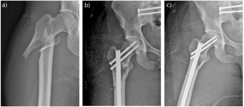 Subtrochanteric Femur Fractures: Anatomy, Classification, and Treatment Options