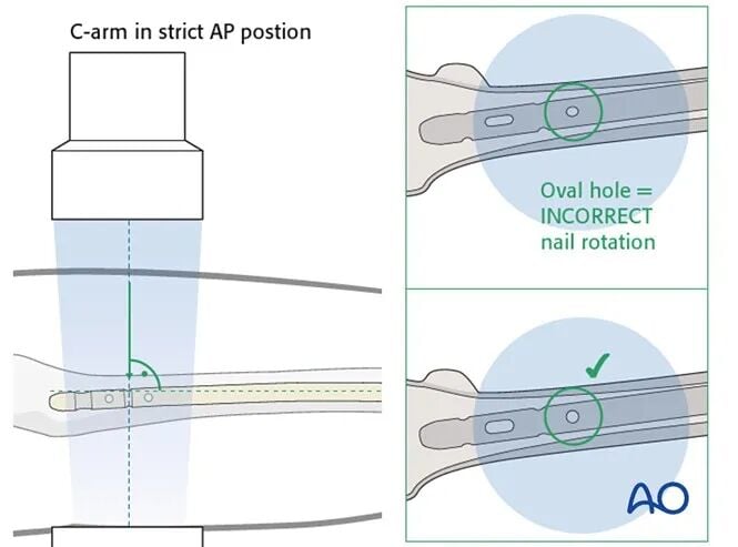 Retrograde Intramedullary Nailing for Periprosthetic Femoral Fractures After TKA: AO Standardized Surgical Strategy – Illustrated Step-by-Step Guide