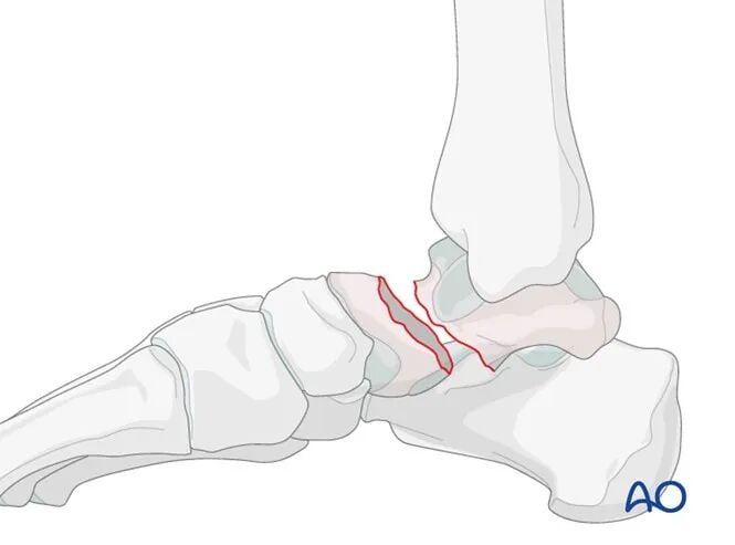 AO Standard Surgery: Screw Fixation for Displaced Talar Neck Fractures