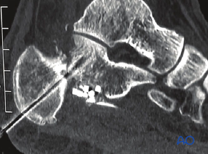 Minimally Invasive K‑Wire and Screw Fixation for Calcaneal Fractures