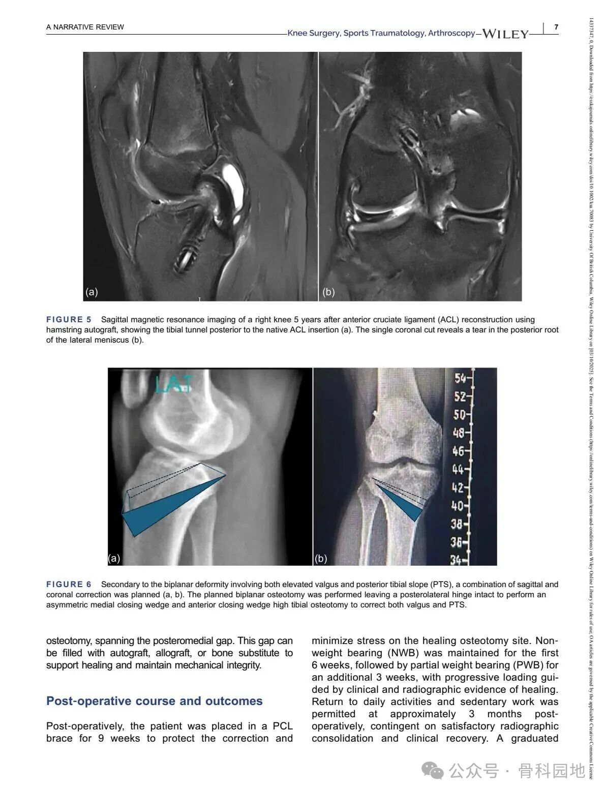 Technical Tips and Tricks for Complex Biplanar High Tibial Osteotomy