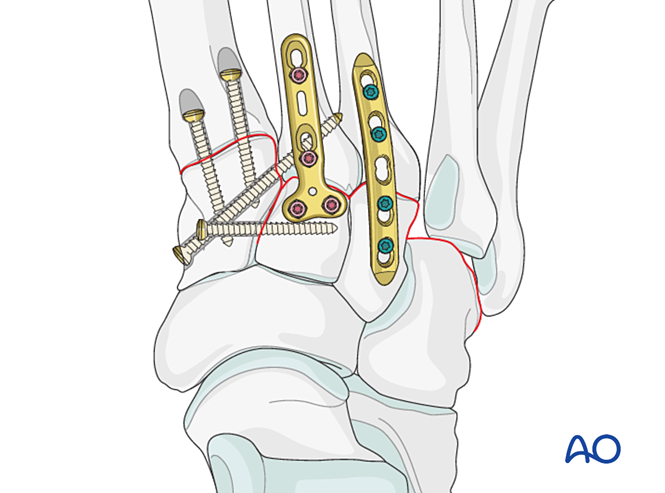 IV. Approach Preparation