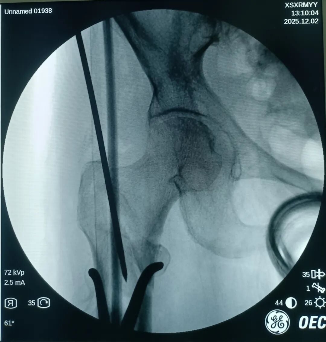 The "Gold Standard Procedure" in Orthopedics: Intramedullary Nailing for Intertrochanteric Fractures – Precise Reduction + Fast Recovery