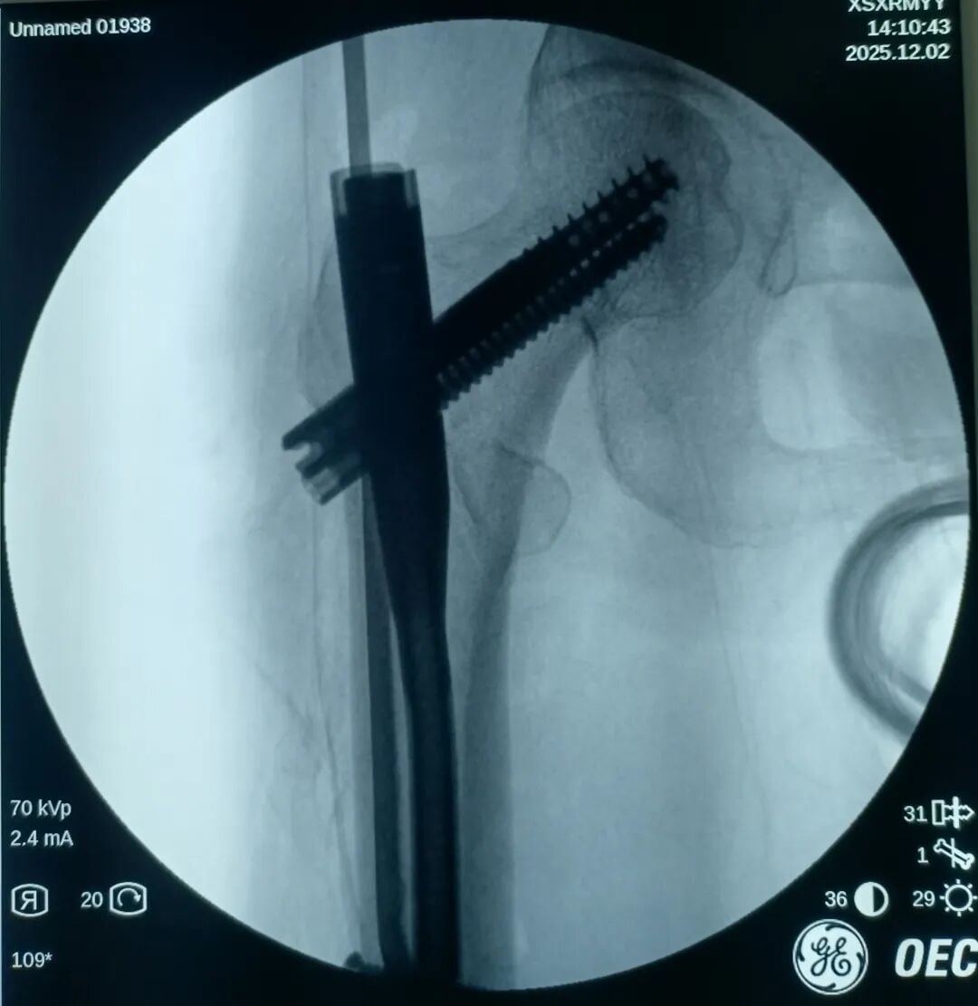 The "Gold Standard Procedure" in Orthopedics: Intramedullary Nailing for Intertrochanteric Fractures – Precise Reduction + Fast Recovery