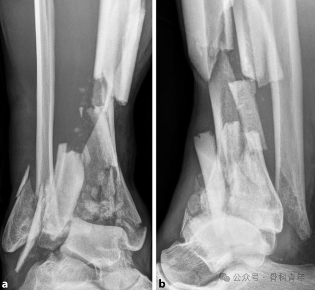 Complex Pilon Fractures: The "Four Principles" and the "Four-Step Foundation Method"