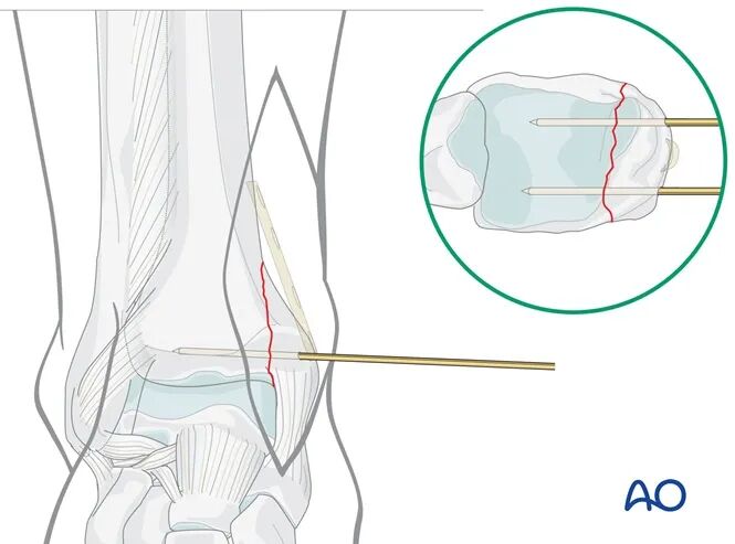 ao standard technique buttress plate fixation for medial malleolus fractures-1