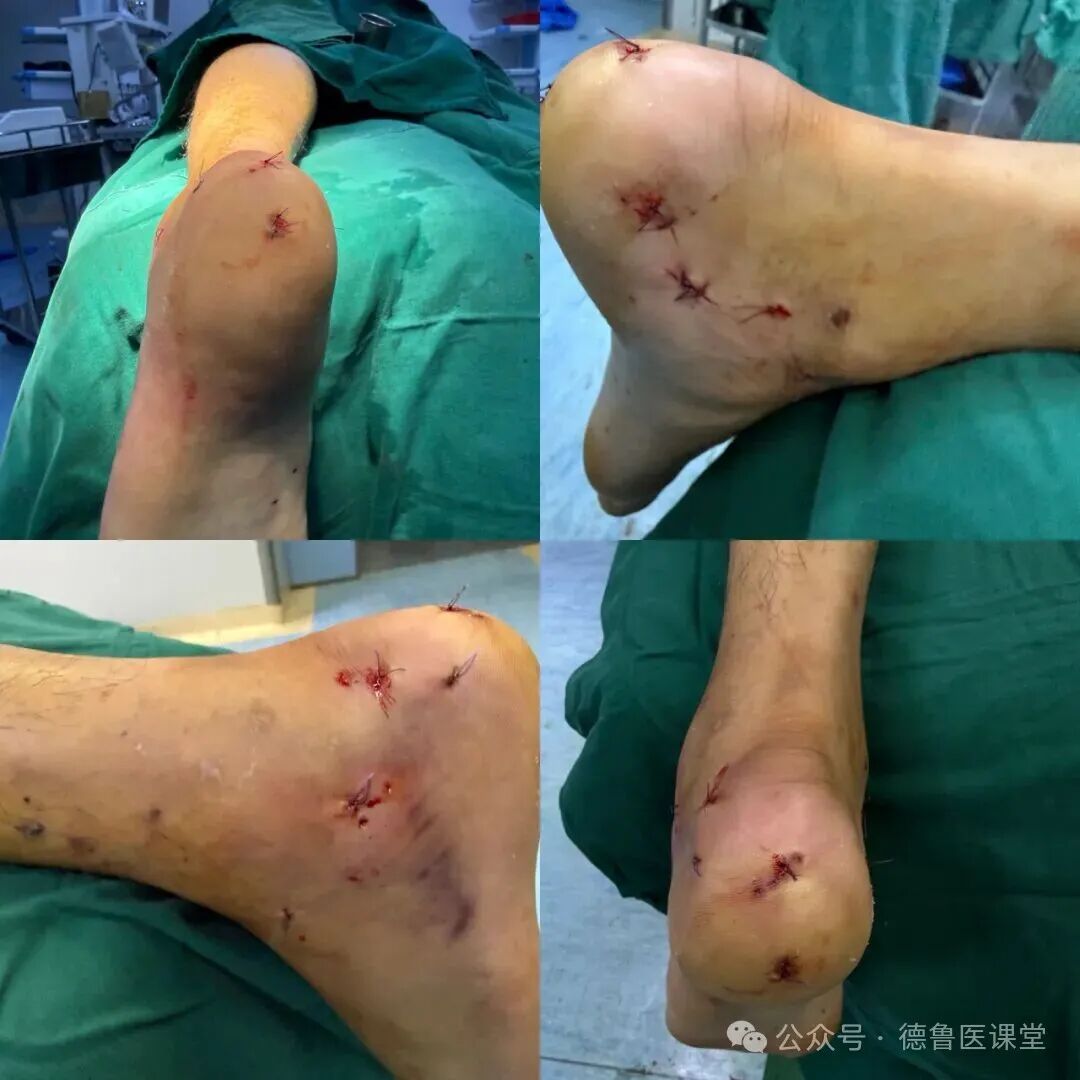 How to Perform a Successful Minimally Invasive Calcaneal Surgery