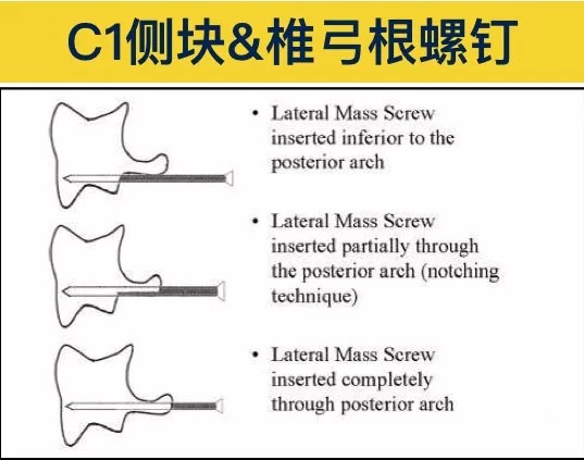 Pedicle Screw Placement Techniques for the Cervical, Thoracic, and Lumbar Spine
