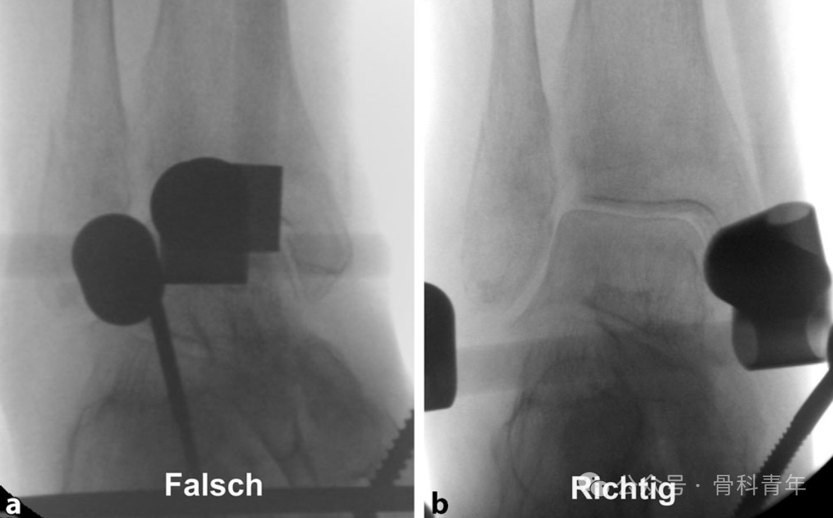 Surgical Steps