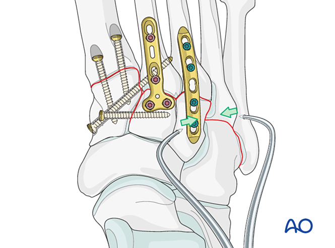 IV. Approach Preparation